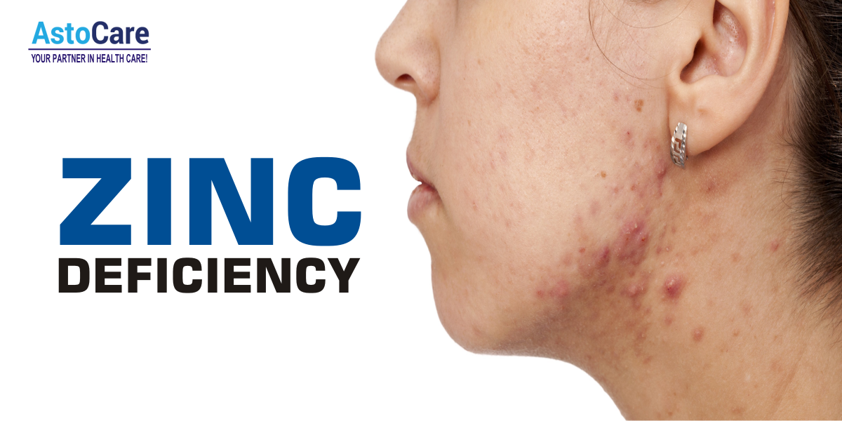 Diagnoses Of Zinc Deficiency