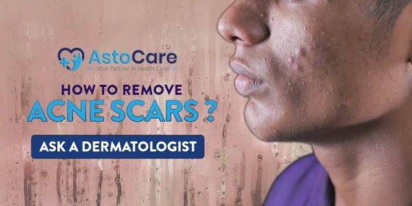 How To Remove Acne Scars Ask A Dermatologist